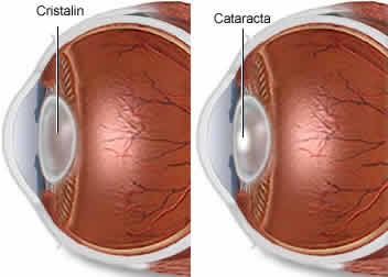 cataracta
