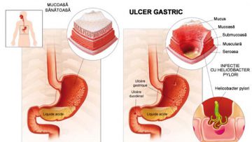 dieta-ulcer-gastric