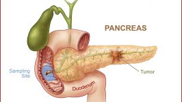 Dietoterapie in pancreatita