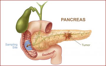 dietoterapie pancreatica