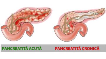 pancreatita-acuta